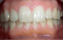 Davide after treatment