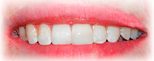 Fractured Tooth After