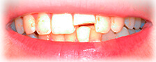 Fractured Tooth Before