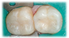 CASE #10: Cosmetic Restoration - White Filling (after)