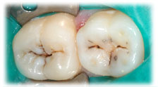 CASE #10: Cosmetic Restoration - White Filling (before)