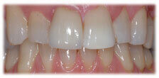 CASE #12: Veneers - Stained Teeth (after)
