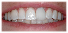 CASE #13: Emergency Treatment - Fractured Tooth (after)