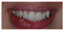 CASE #15: Emergency Treatment - Fractured Tooth (after)