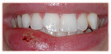 CASE #15: Emergency Treatment - Fractured Tooth (before)