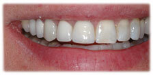 CASE #16: Broken/Fractured Tooth (after)