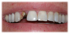 CASE #16: Broken/Fractured Tooth (before)