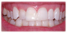 CASE #17: Emergency Treatment - Broken Teeth (after)