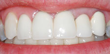 CASE #19:  Emergency Treatment - Fractured Tooth (after)