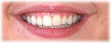 After - CASE # 2: Cosmetic Dentistry - Lumineers