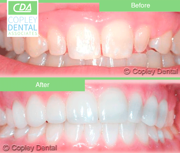 CASE # 2: Cosmetic Dentistry - Lumineers