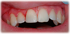 CASE #20: Broken/Fractured (after)