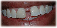 CASE #21: Emergency Treatment - Fractured Tooth (after)