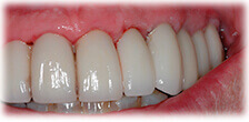 CASE #22:  Cosmetic Restoration (after)