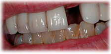 CASE #22:  Cosmetic Restoration (before)