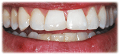 CASE #23: Emergency Treatment - Fractured Tooth (after)