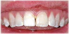 CASE #24: Broken / fractured tooth (after)