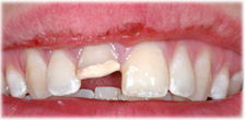 CASE #24: Broken / fractured tooth (before)
