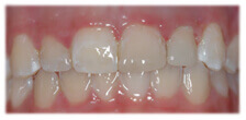 CASE #25: Emergency Treatment - Fractured Tooth (after)