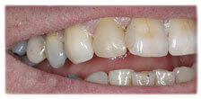 CASE #26:  Broken / fractured Tooth (after)