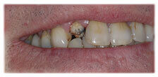 CASE #26:  Broken / fractured Tooth (before)