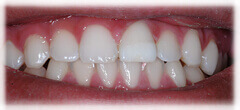 CASE #27: Emergency Treatment - Fractured Tooth (after)