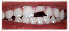 CASE #27: Emergency Treatment - Fractured Tooth (before)