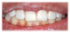 CASE #28: Broken / fractured tooth (after)