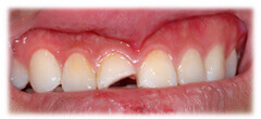 CASE #28: Broken / fractured tooth (before)