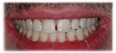 CASE #29: Emergency Treatment - Broken Teeth (after)