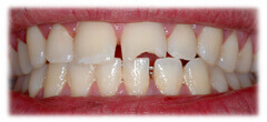 CASE #29: Emergency Treatment - Broken Teeth (before)