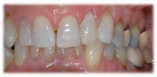 After - CASE # 3: Emergency Treatment - Fractured or Broken Tooth