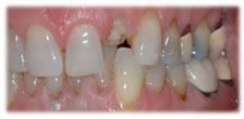 Before - CASE # 3: Emergency Treatment - Fractured or Broken Tooth