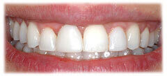 CASE #30: Cosmetic Lengthening (after)