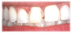 CASE #30: Cosmetic Lengthening (before)