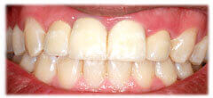 CASE #31: Cosmetic Restoration (after)