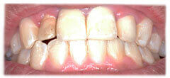 CASE #31: Cosmetic Restoration (before)