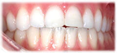 CASE #33: Emergency Treatment - Fractured Tooth (after)