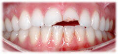 CASE #33: Emergency Treatment - Fractured Tooth (before)