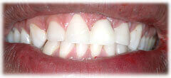 CASE #34: Emergency Treatment - Fractured Tooth (after)