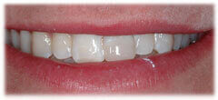 CASE #35: Broken / fractured tooth (after)