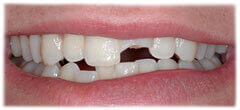 CASE #35: Broken / fractured tooth (before)