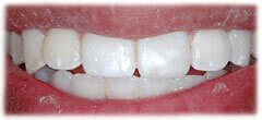 CASE #36: Emergency Treatment - Broken tooth (after)