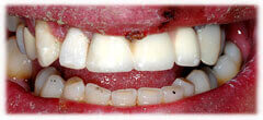 CASE #37: Broken / fractured tooth (after)