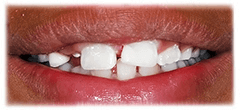 CASE #38: Emergency Treatment - Fractured tooth (after)