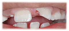 CASE #38: Emergency Treatment - Fractured tooth (before)