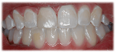 CASE #39: Emergency Treatment - Broken tooth (after)