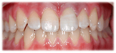 CASE #40: Emergency Treatment - Fractured Tooth (after)