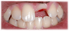 CASE #40: Emergency Treatment - Fractured Tooth (before)