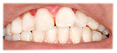 CASE #41: Emergency Treatment - Fractured Tooth (after)